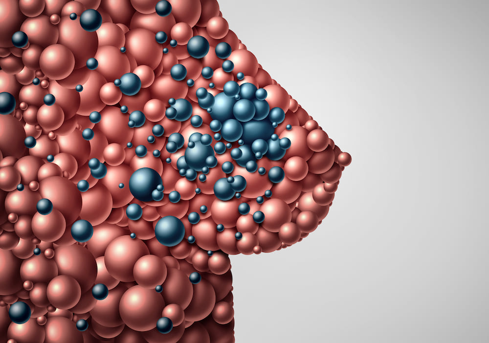 Systematic review fills knowledge gaps about metastatic breast cancer