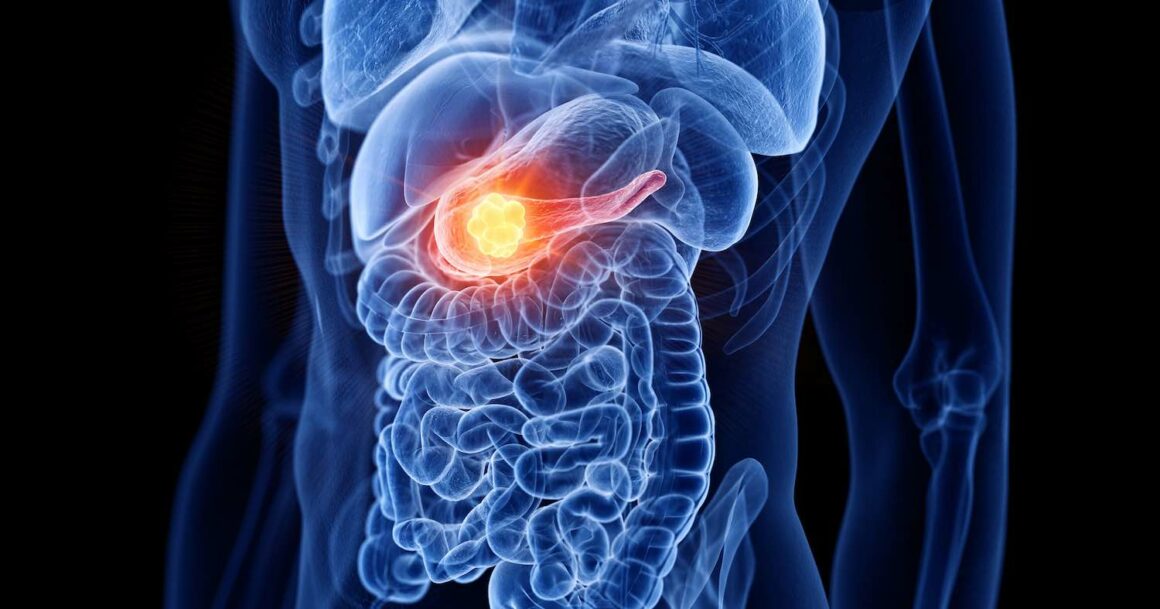 Pancreatic cancer patients diagnosed early through screening achieve long-term survival