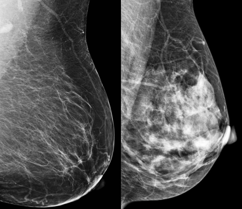 Biological differences revealed between dense and nondense breast tissue