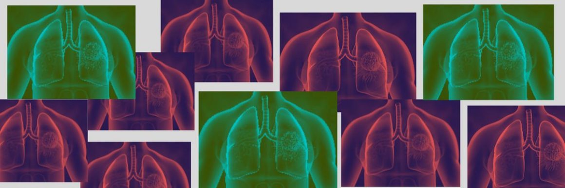 Four-protein biomarker test helps personalise lung cancer screening