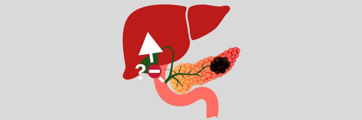 Potential new target to prevent pancreatic cancer from spreading to liver