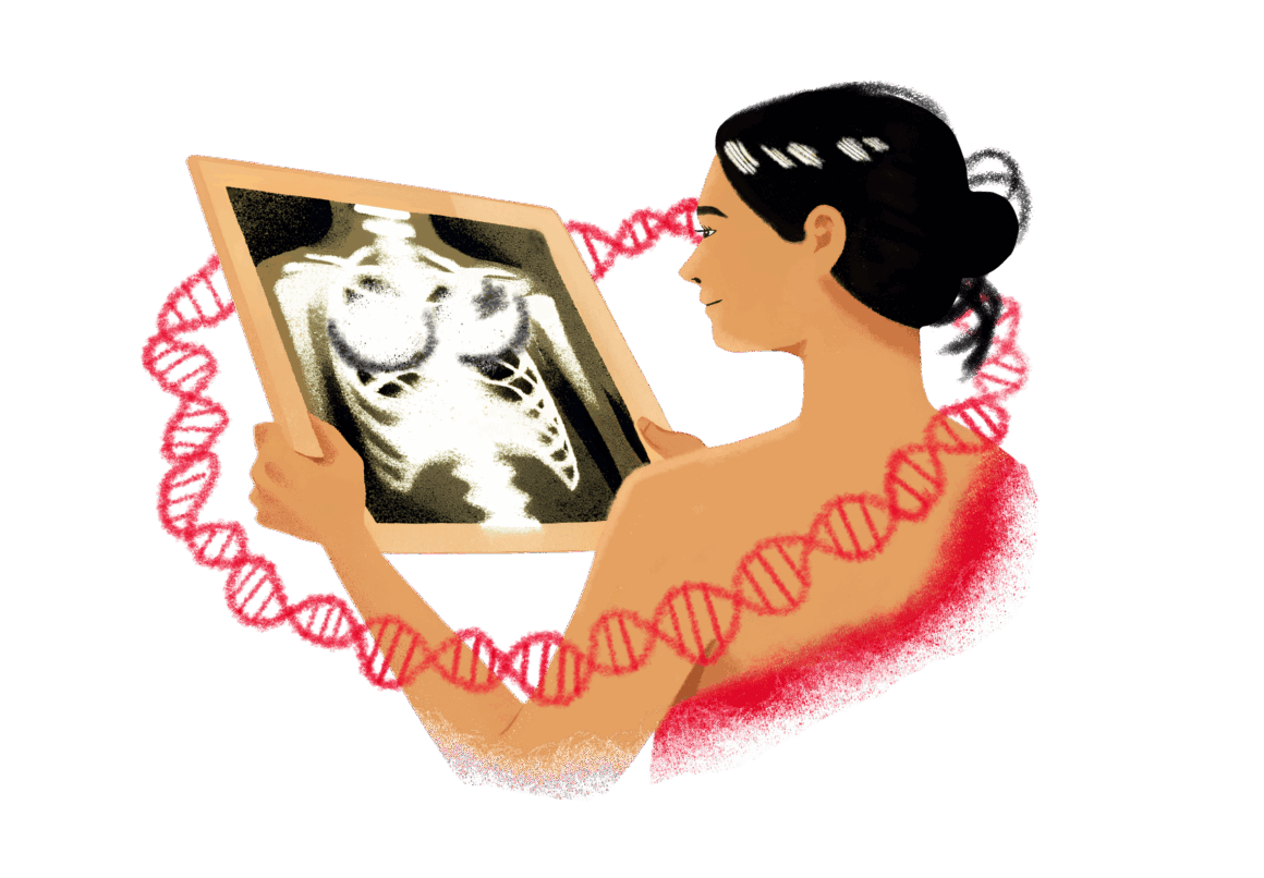BRCA1/BRCA2 Mutations Carriers at Greater Risk for Anaplastic Large Cell Lymphoma Associated with Breast Implants
